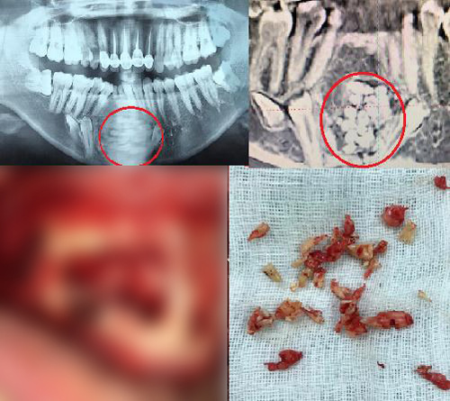 Ám ảnh kinh hoàng từ căn bệnh U răng hiếm gặp tại Việt Nam - 4