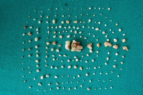 Ám ảnh kinh hoàng từ căn bệnh U răng hiếm gặp tại Việt Nam - 6