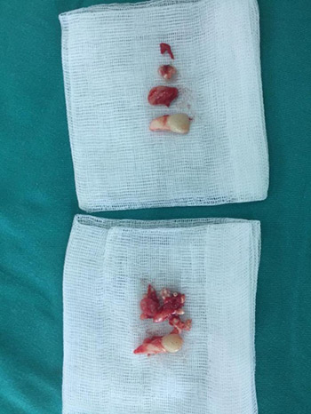 Ám ảnh kinh hoàng từ căn bệnh U răng hiếm gặp tại Việt Nam - 7