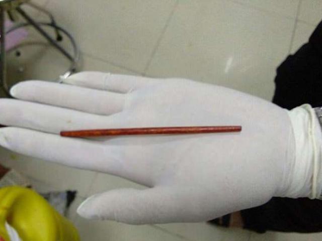 Phi thường - kỳ quặc - Vụ người đàn ông VN bị bạn nhậu nhét chiếc đũa vào "của quý" lên báo Anh