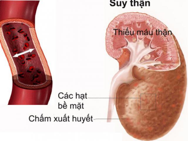 Bệnh thận ảnh hưởng tới tình dục thế nào?