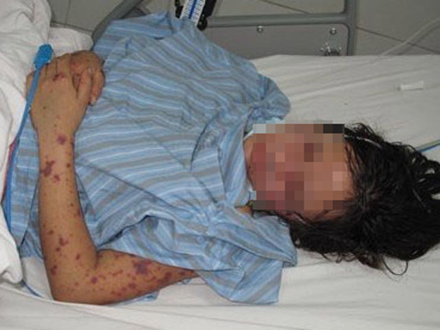 Sức khỏe đời sống - Dấu hiệu nhận biết virus “ăn não” đang khiến cô gái 24 tuổi hôn mê