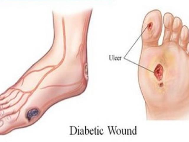 Sức khỏe đời sống - Cứ 30 giây có 1 ca cắt bỏ chân do đái tháo đường
