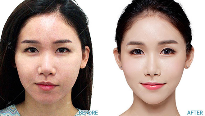 Cấy mỡ mặt Baby Face - xu hướng trẻ hóa gương mặt ưa chuộng 2018 - 3