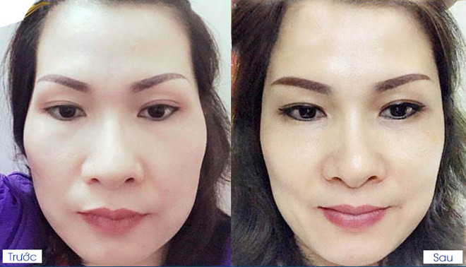 Kết quả hình ảnh cho Thông cơ má baby