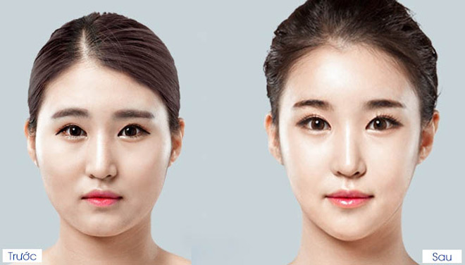 Cấy mỡ mặt Baby Face - xu hướng trẻ hóa gương mặt ưa chuộng 2018 - 5