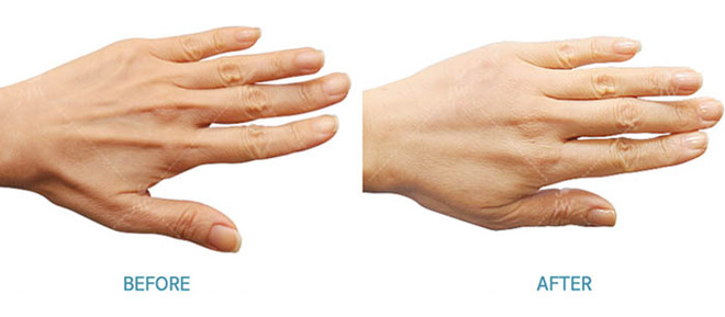 Cấy mỡ mặt Baby Face - xu hướng trẻ hóa gương mặt ưa chuộng 2018 - 6