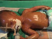 Bệnh lạ: Em bé "ni lông" chào đời ở Ấn Độ