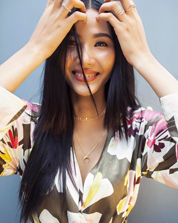 Hoàng Thùy khoe mình là á hậu đầu tiên đeo niềng răng - 1