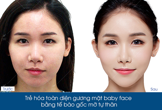 100 cơ hội cấy mỡ trẻ hoá công nghệ Hàn Quốc chỉ với 50% chi phí - 3