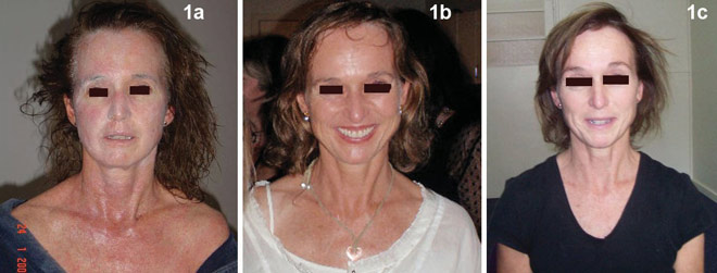 Điều trị viêm da cơ địa mãn tính bằng thảo dược - 2