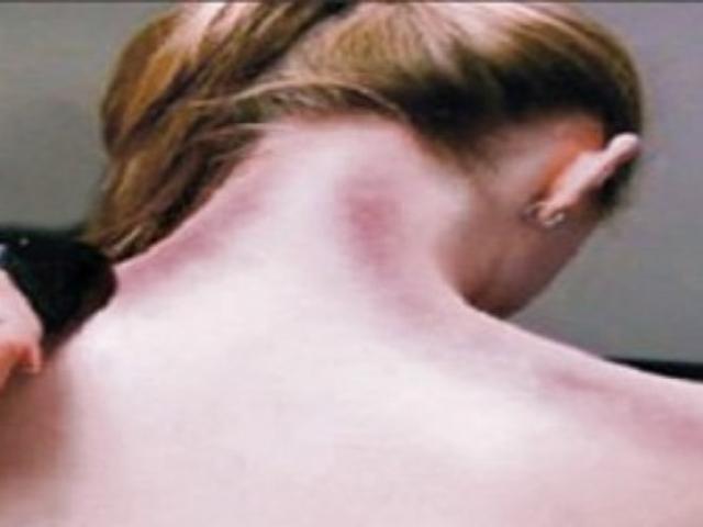 Sức khỏe đời sống - Cạo gió cũng có "chống chỉ định"