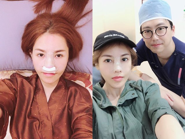 Bí quyết làm đẹp - Tình cũ Trường Giang "dao kéo" lần 6 để có mũi Song Hee Kyo