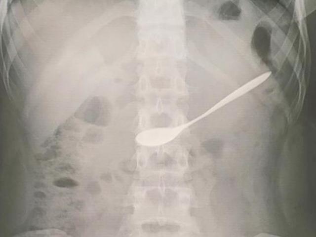 Sức khỏe đời sống - Hi hữu: Đi uống cà phê, cô gái 20 tuổi lỡ nuốt thìa sắt vào bụng