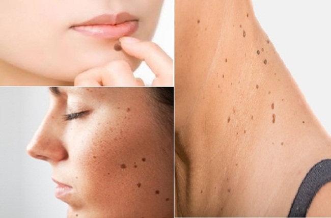 Những điều &#34;hoang đường&#34; về nốt ruồi, cứ hiểu sai có ngày hối hận - 2