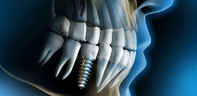 Cấy ghép implant OP300 giúp phục hình răng đã mất một cách hoàn hảo - 1