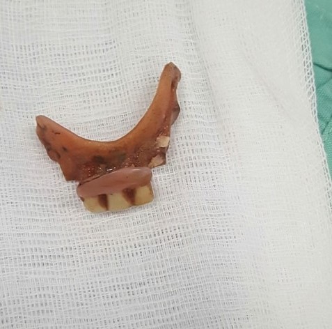 Uống thuốc nuốt luôn hàm răng giả mà không hề hay biết - 1