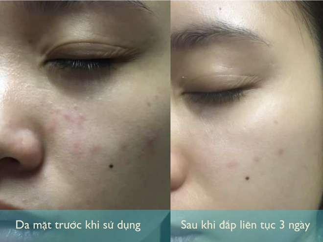 Chăm chỉ đắp loại mặt nạ này trong 7 ngày liên tục, bạn sẽ không khỏi ngạc nhiên trước làn da mới căng bóng và trắng mịn - 1