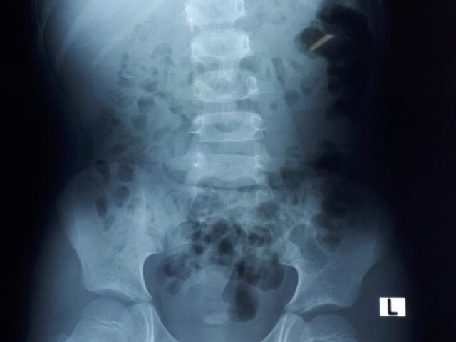 Sức khỏe đời sống - Mẹ “tá hỏa” khi bác sĩ phát hiện đầy sỏi trong thận của con trai 8 tuổi