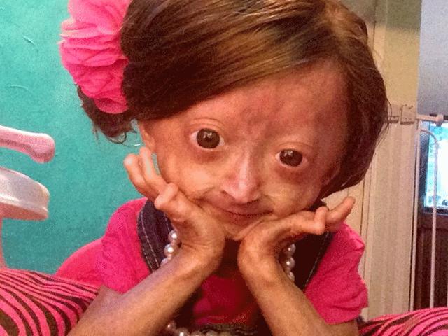 Media - Cuộc sống kỳ lạ của cô bé mang hình hài bà lão U80