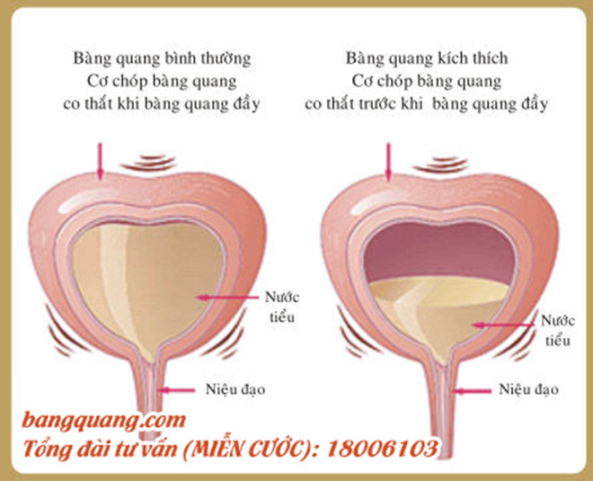 Hội chứng bàng quang kích thích - “Kẻ chủ mưu” gây tiểu són, tiểu nhiều lần - 1