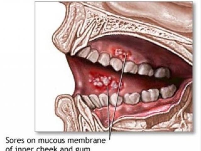 Sức khỏe đời sống - Bị ung thư vì thứ triệu người mê