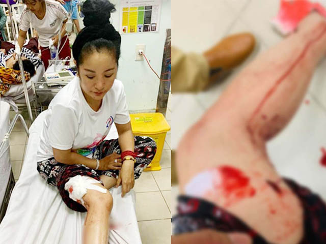 Phim - Danh hài Thuý Nga gặp tai nạn, phải nhập viện khâu 10 mũi