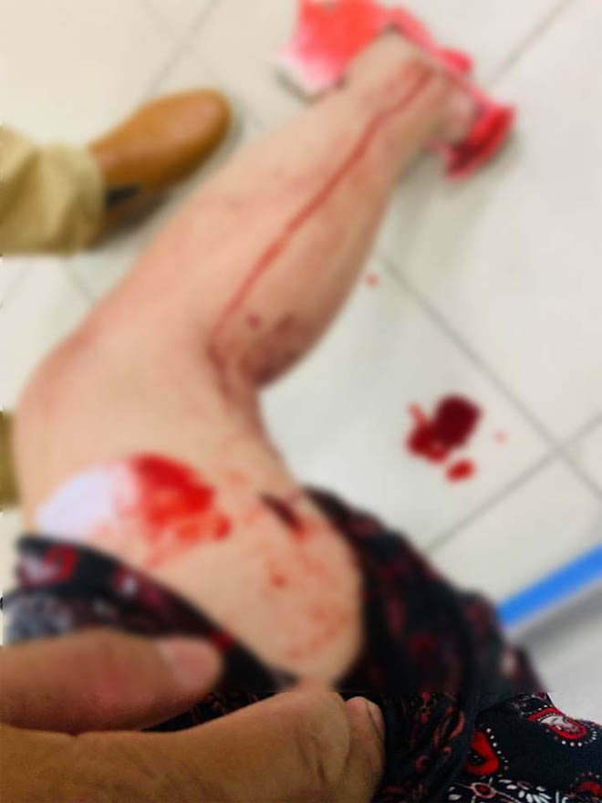 Danh hài Thuý Nga gặp tai nạn, phải nhập viện khâu 10 mũi - 2