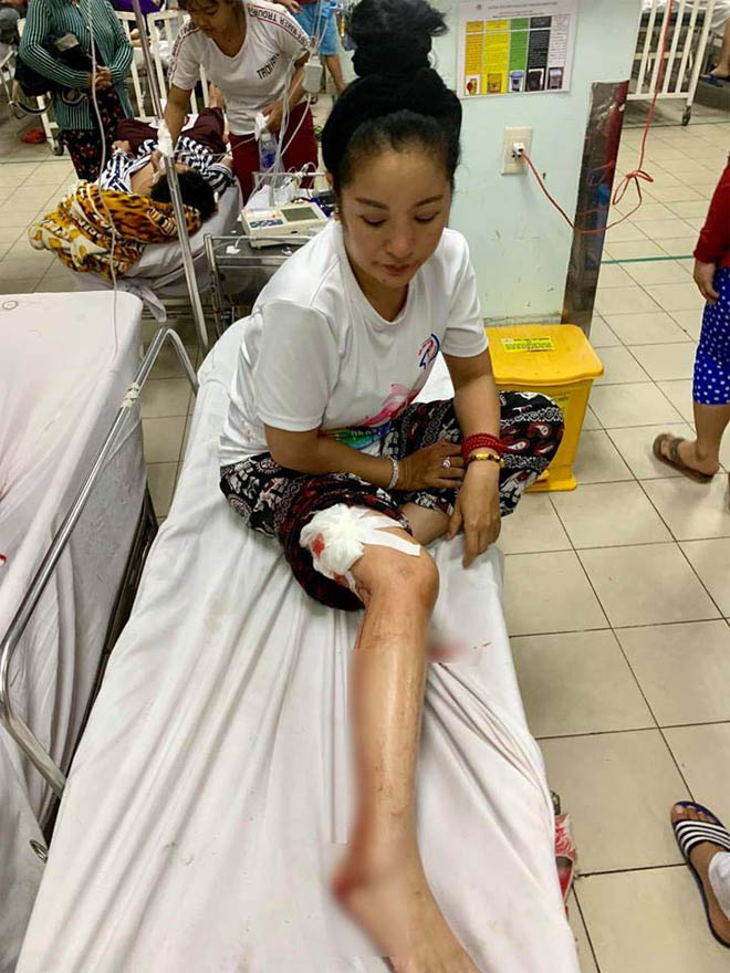 Danh hài Thuý Nga gặp tai nạn, phải nhập viện khâu 10 mũi - 1