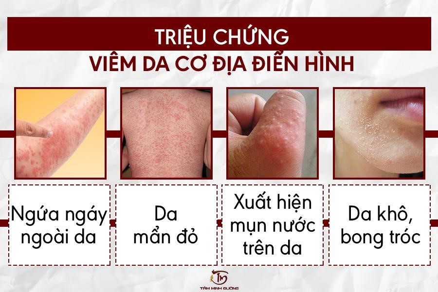 Viêm da cơ địa dị ứng ở tay, chân, mặt người lớn kiêng ăn gì? - 2