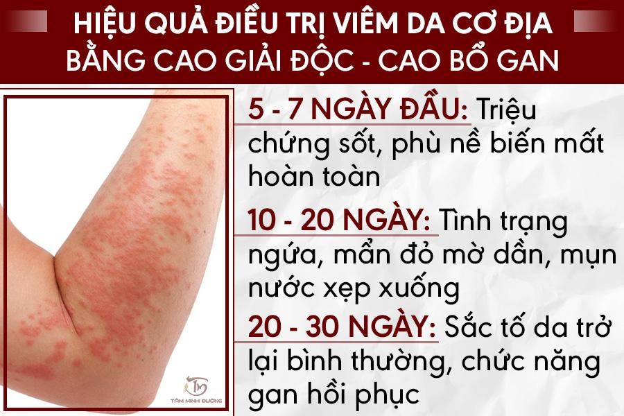Viêm da cơ địa dị ứng ở tay, chân, mặt người lớn kiêng ăn gì? - 5