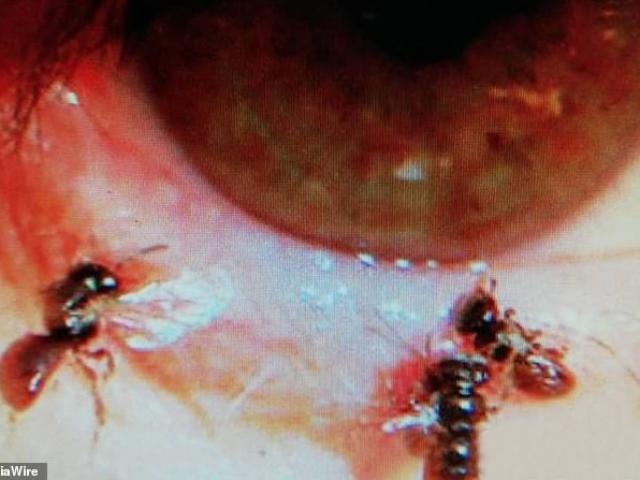 Phi thường - kỳ quặc - Đáng sợ loài vật chui hẳn vào mắt người để uống nước mắt