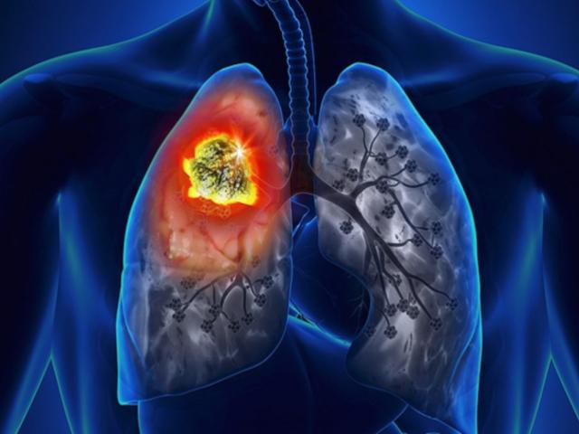 Loại quả cả thế giới đều dùng nhưng không biết nó là ”khắc tinh” ung thư phổi