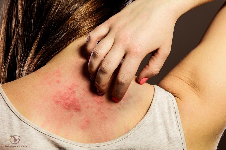 Cách chữa nổi mề đay mẩn ngứa cấp và mãn tính theo chuyên gia - 1