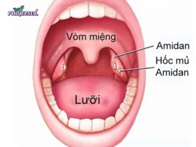 Viêm amidan: Phân loại, triệu chứng, nguyên nhân và cách đẩy lùi hiệu quả - 1