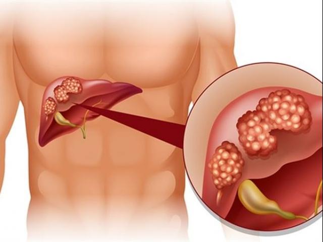 Thực phẩm hại gan khủng khiếp nhiều người Việt mê ăn hằng ngày