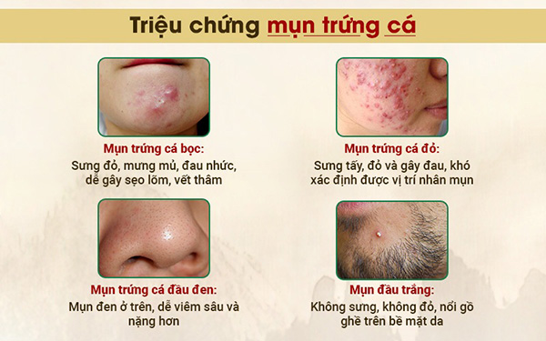 Mụn trứng cá là gì? Hỗ trợ trị mụn trứng cá hiệu quả từ thảo dược - 1