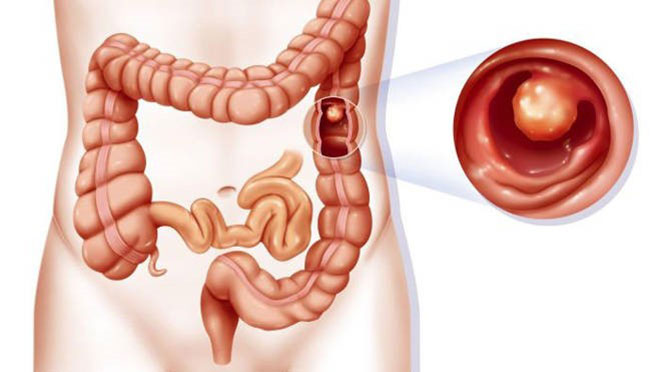 Triệu chứng bệnh đại tràng nhận biết sớm xử lý để phòng ung thư - 2