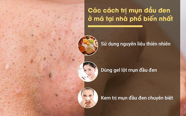 Hỗ trợ trị mụn đầu đen ở má hiệu quả bất ngờ từ thảo dược Đông y - 1