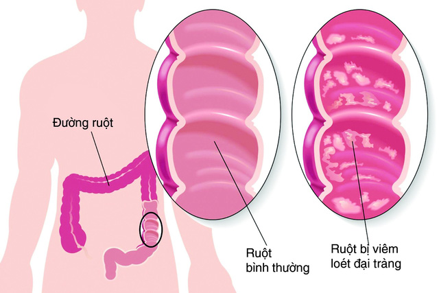 Bảo vệ đại tràng nhờ bào tử lợi khuẩn LiveSpo Colon - 1
