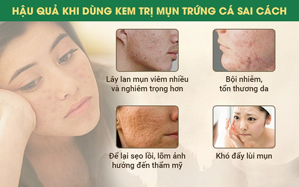 Kem trị mụn trứng cá dùng sai khiến mụn nặng hơn và giải pháp từ thảo dược - 1