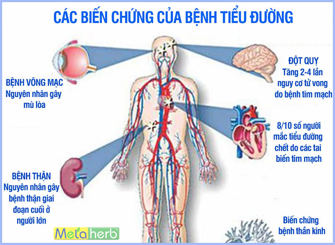 Bệnh tiểu đường là gì? Triệu chứng, cách phòng ngừa biến chứng đái tháo đường - 3