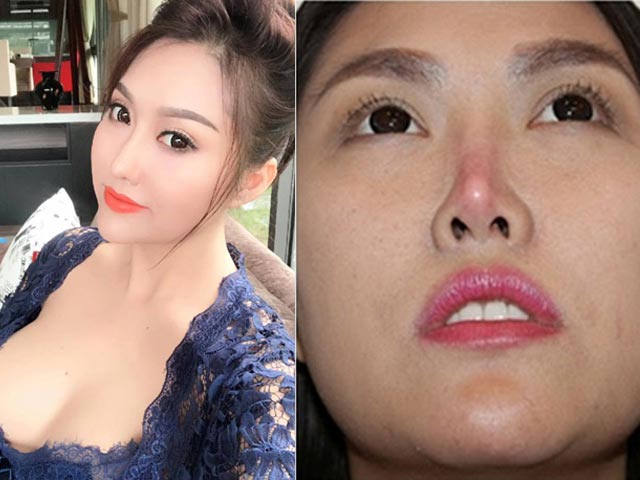 Làm đẹp - Phi Thanh Vân, Lệ Quyên, Ngân 98... gặp sự cố vì sửa mũi