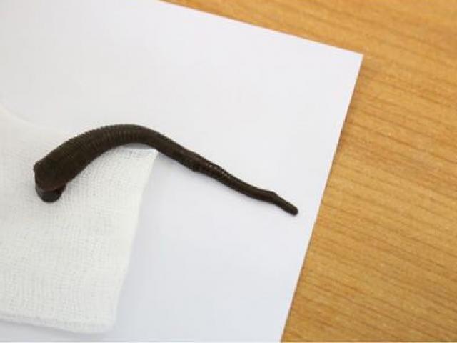 Sức khỏe đời sống - Hoảng hồn vì những con đỉa trốn kỹ trong cơ thể người tới mức bác sĩ khó tìm