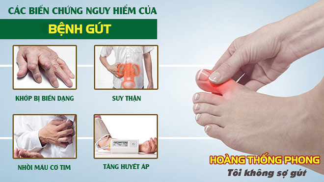 Hoàng Thống Phong: Ngăn chặn biến chứng của bệnh gút - 1