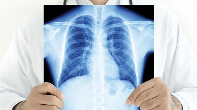 Bệnh ung thư 'sát thủ' khiến hơn 20.000 người Việt chết mỗi năm - 3