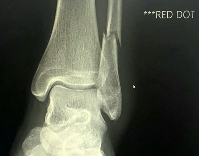 Cả thế giới phải nể: Mỹ nữ gãy chân vẫn chạy 29km về đích - 3