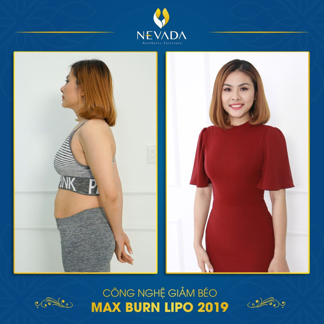 Tại sao Max Burn Lipo là phương pháp giảm béo đáng để bạn lựa chọn? - 1