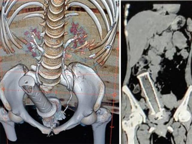 Phi thường - kỳ quặc - Ấn Độ: Chồng say rượu có hành động điên rồ vào "vùng kín" của vợ