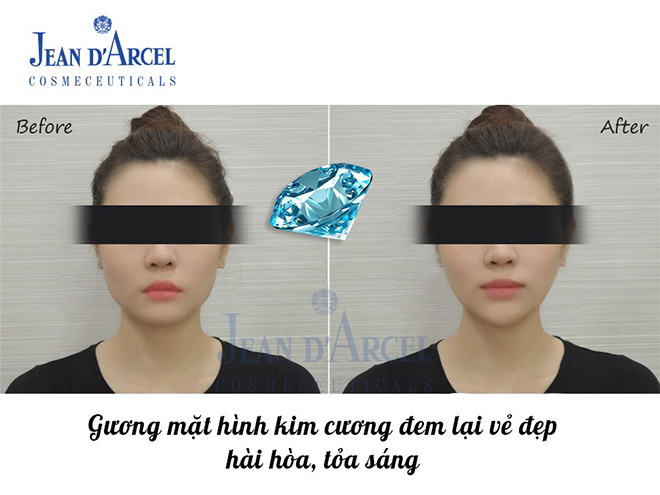 Công nghệ Diamond Face tạo xu hướng thẩm mỹ 2019 - 2